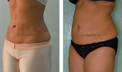 Before And After Body Lift Surgery Results On Abdomen