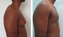 Side View Of A Male Patient Before And After Gynecomastia Treatment