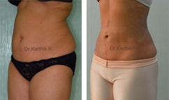 Body Contouring Before &Amp; After Photos