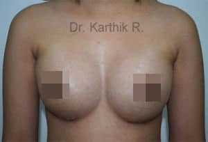 Woman’s Chest After Breast Augmentation Surgery