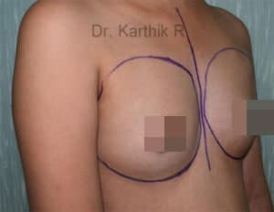 Side View Before Breast Augmentation With Surgical Markings
