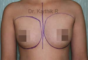 Female Chest Before Breast Augmentation Surgery