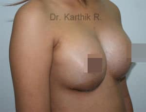 Side View Of Patient After Breast Augmentation Procedure