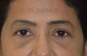 Blepharoplasty