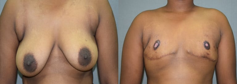 Ftm Heavy Breasts - Phase 1