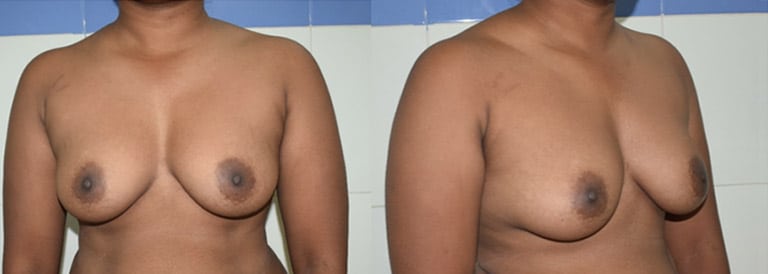 Ftm Heavy Breasts - Phase 2