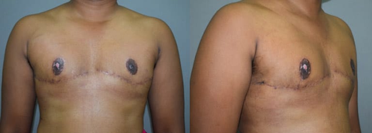 Ftm Heavy Breasts - Phase 3