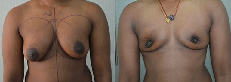 Ftm Moderate Breasts