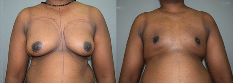 Ftm Small Breasts