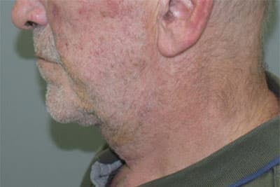 Naso Labial Fold