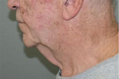 Naso Labial Fold