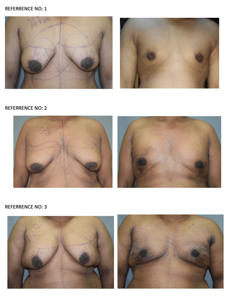 Gynecomastia Before and After