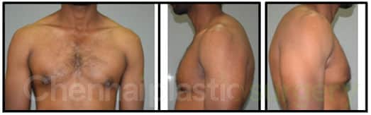 Gynecomastia Before And After Photos