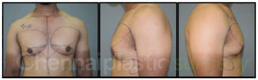 Gynecomastia Before And After Photos