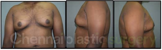 Gynecomastia Before And After Photos