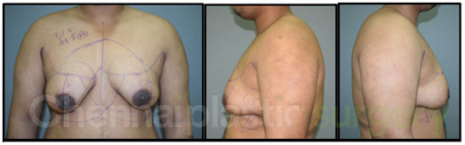 Gynecomastia Before and After Photos