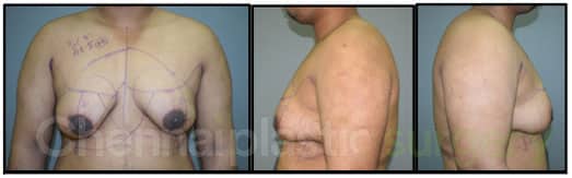 Gynecomastia Before And After Photos