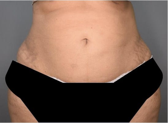 Vaser Lipo Before And After Photos