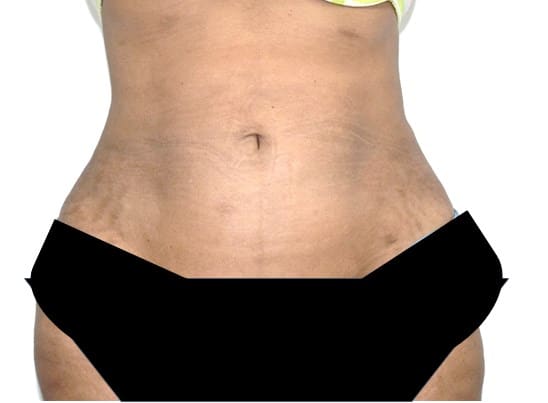Vaser Lipo Before And After Photos
