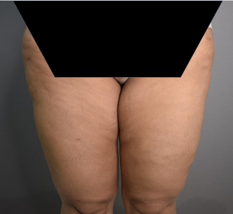 Vaser Lipo Before and After Photos