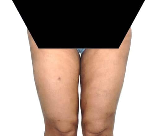 Vaser Lipo Before And After Photos