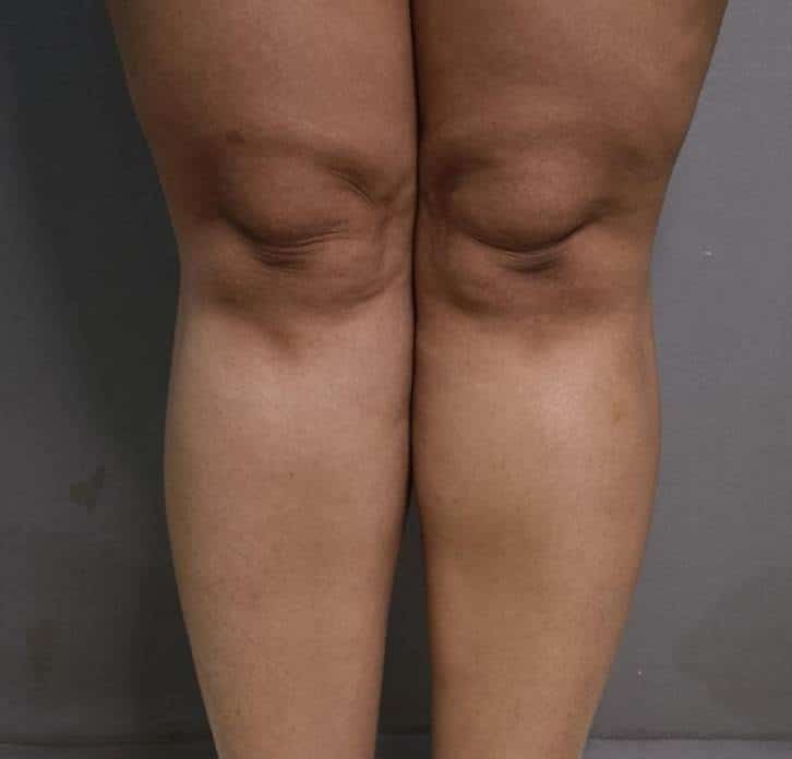 Vaser Lipo Before And After Photos