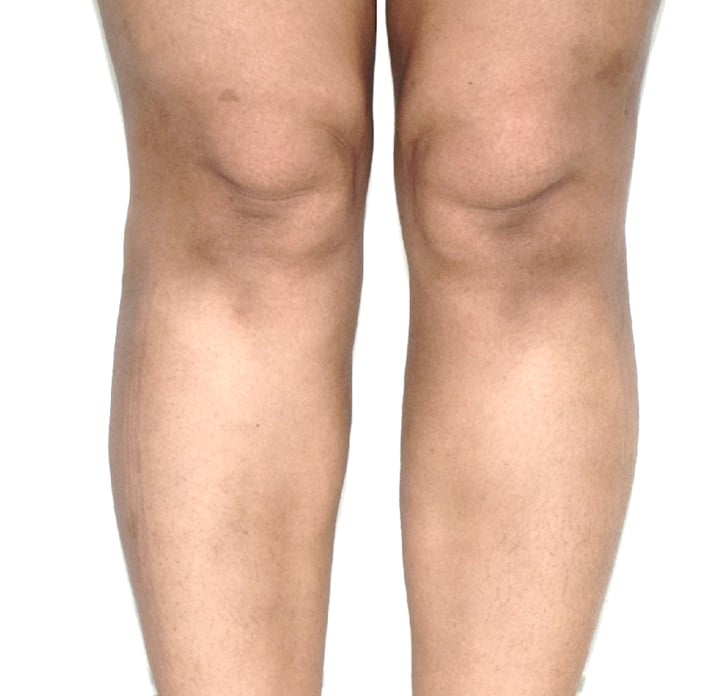 Vaser Lipo Before And After Photos