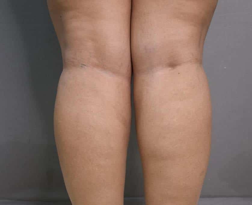 Vaser Lipo Before And After Photos