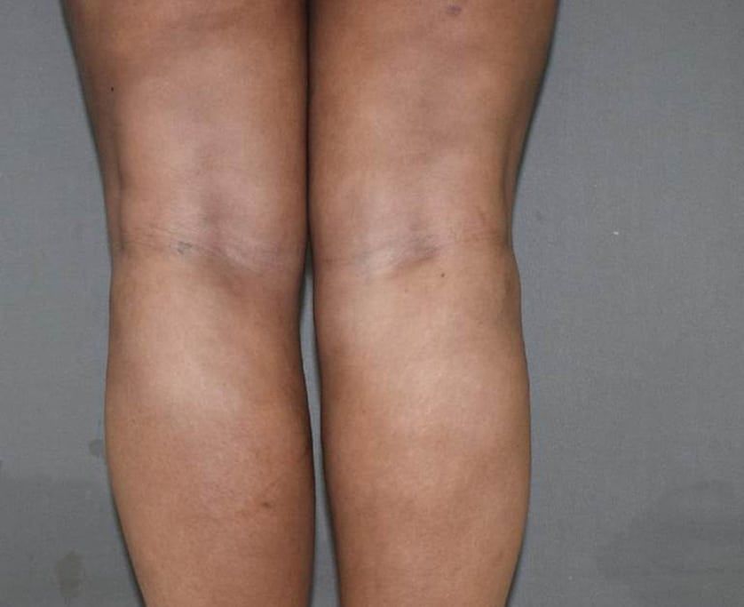 Vaser Lipo Before And After Photos