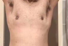 Gynecomastia After