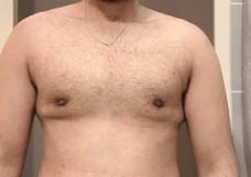 Gynecomastia Before