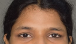 Forehead Lift