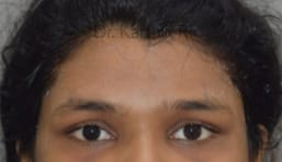 Forehead Lift