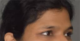 Forehead Lift
