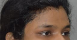 Forehead Lift