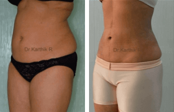 Body Contouring Before & After Photos
