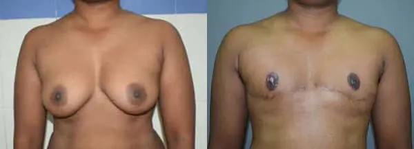 gender reassignment before and after photo by chennai plastic surgery in india