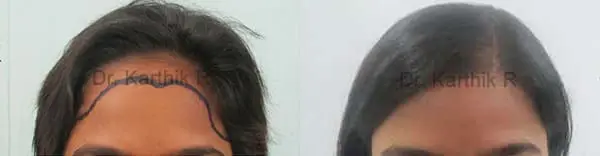 female hairline advancement before and after photo by chennai plastic surgery in india