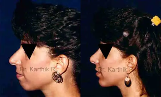 rhinoplasty before and after photo by chennai plastic surgery in india