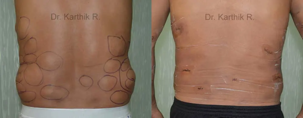 multiple lipoma before and after photo by chennai plastic surgery in india