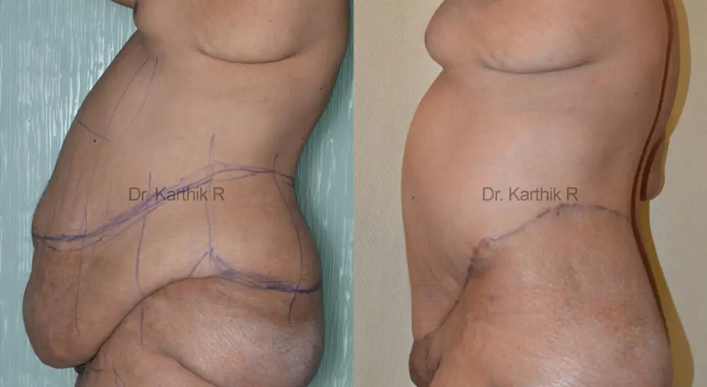 circumferential body lift before and after photo by chennai plastic surgery in india