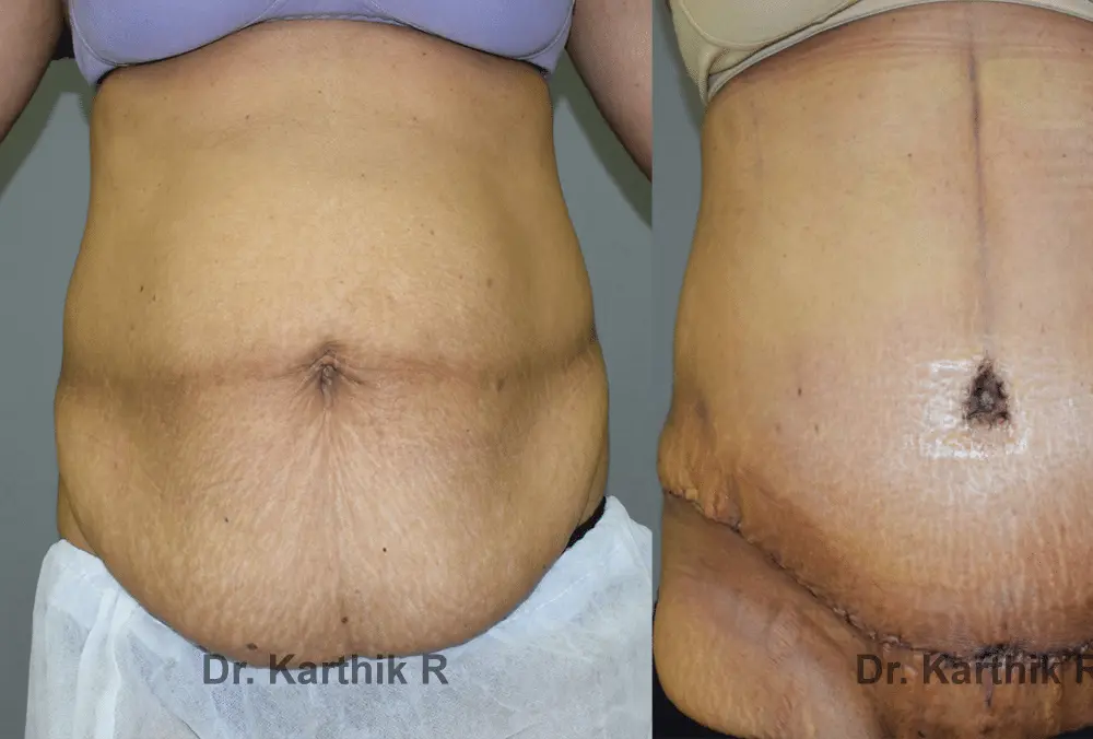 mommy makeover before and after photo by chennai plastic surgery in india