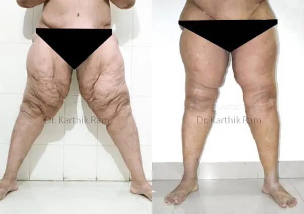 thigh lift before and after photo by chennai plastic surgery in india