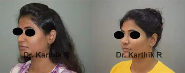 buccal fat before and after photo by chennai plastic surgery in india