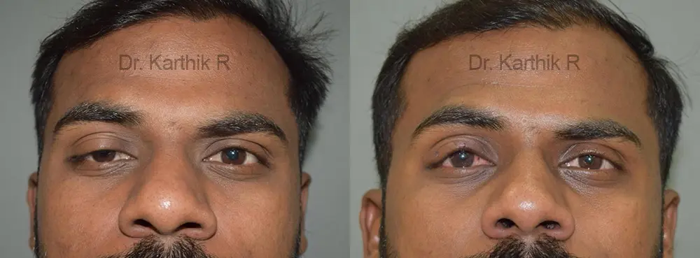 blepharoplasty before and after photo by chennai plastic surgery in india