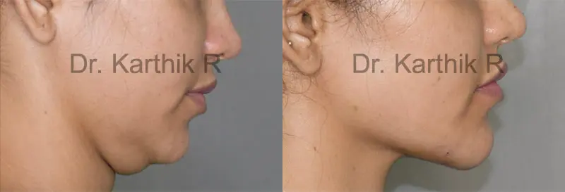 double chin liposuction before and after photo by chennai plastic surgery in india