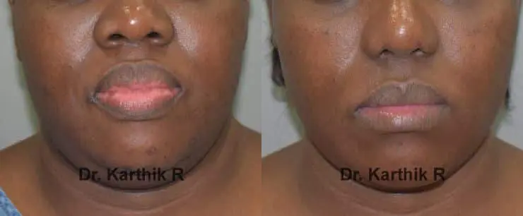 lip correction before and after photo by chennai plastic surgery in india