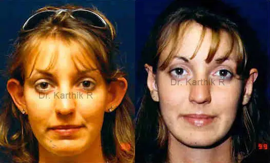 otoplasty ear correction before and after photo by chennai plastic surgery in india