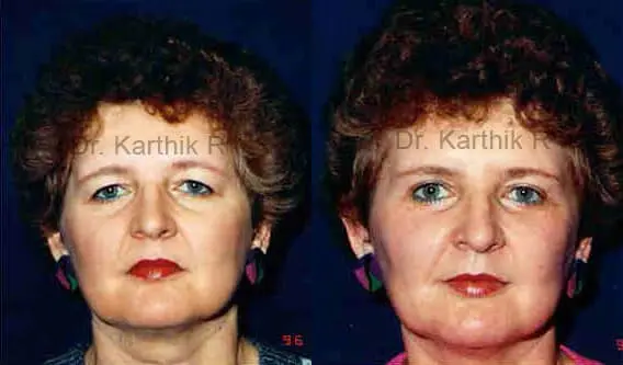 brow lift before and after photo by chennai plastic surgery in india