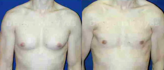 gynecomastia before and after photo by chennai plastic surgery in india
